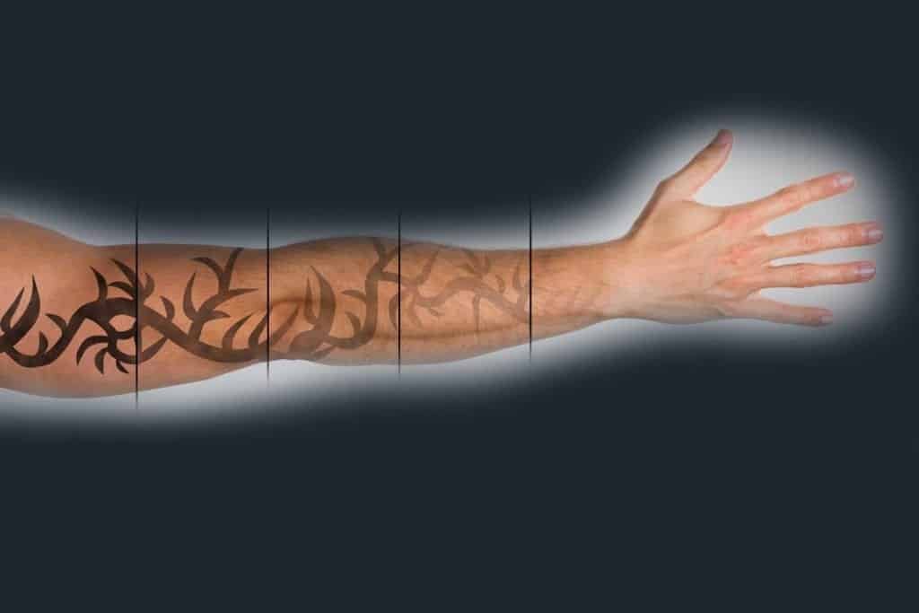 Laser Tattoo Removal Kent